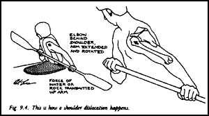 Dislocation